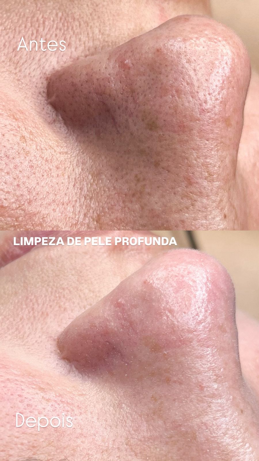 Limpeza de Pele em Vila Bossi, Louveira | Espaço Favorita Beleza e Unhas